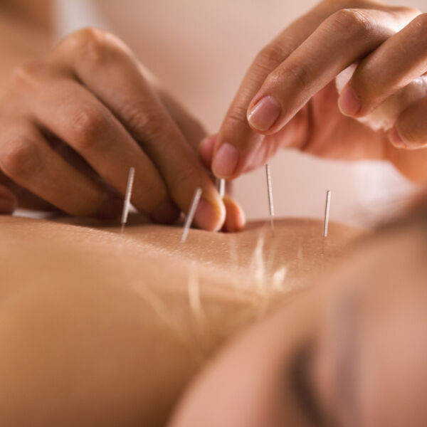 Woman getting accupuncture