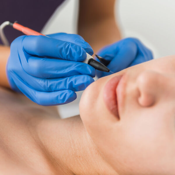 Electrolysis performing electrology on a woman's face